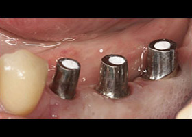 proimages/case/3D-01.png proimages/Case/dentalimplant/09/02/Horny4.jpg